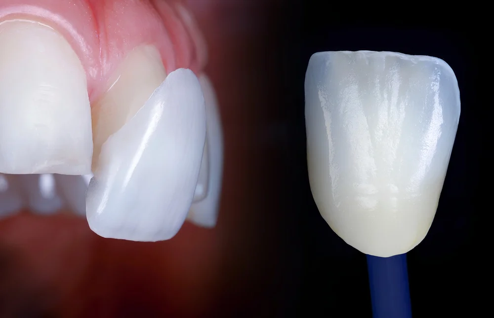 veneers desert hot springs ca