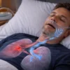 What Causes Sleep Apnea?